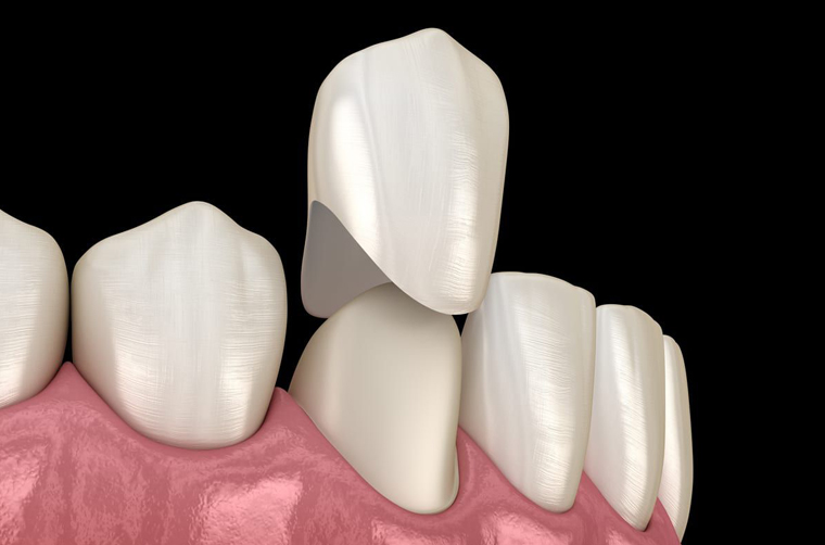 Dental Crowns in Dallas, TX, Floss Dental Dallas