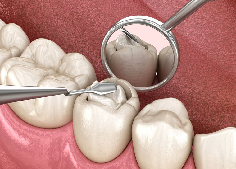 Dental Fillings in Dallas, TX, Floss Dental Dallas