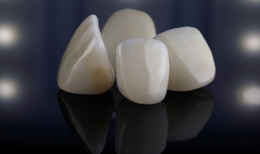 Dental Veneers in Dallas, TX, Floss Dental of Dallas