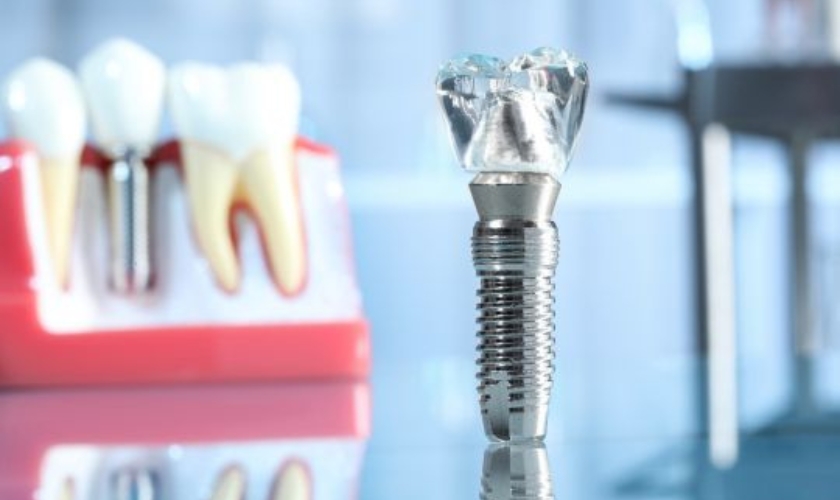 Dental Implants in Dallas