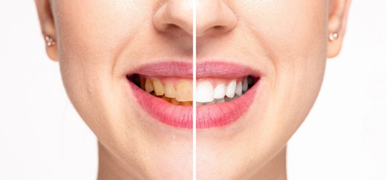 how to maintain your bright smile
