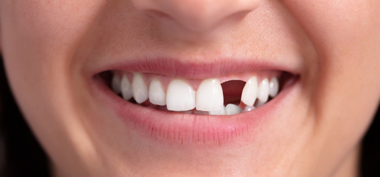 repairing cracked teeth with tooth bonding